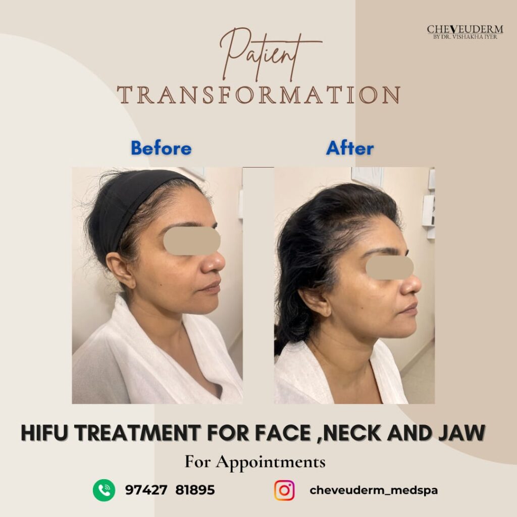 HIFU treatment before and after showing jawline lifting and skin tightening results at Cheveuderm skin clinic in HBR Layout Bangalore