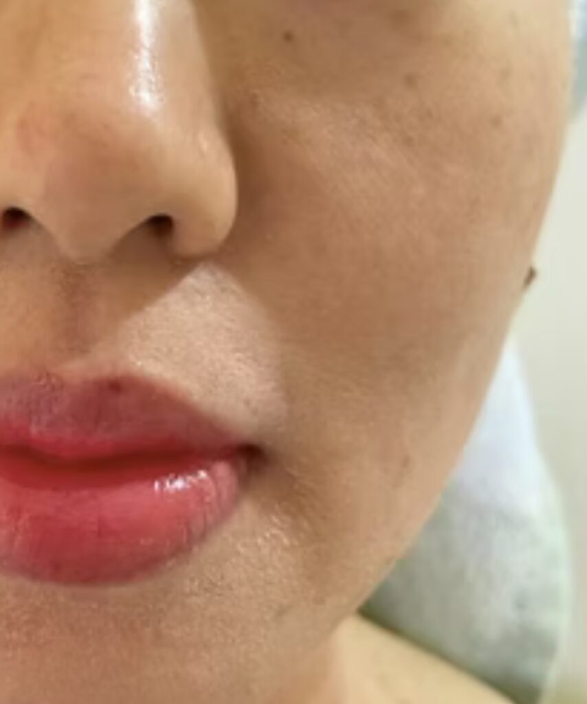 Melasma and pigmentation treatment result after chemical peel at Cheveuderm Bangalore by Dr. Vishakha Iyer