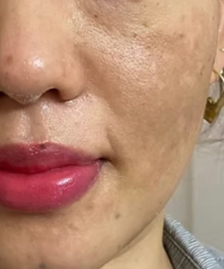 Melasma and pigmentation treatment before photo at Cheveuderm Medspa HBR Layout Bangalore