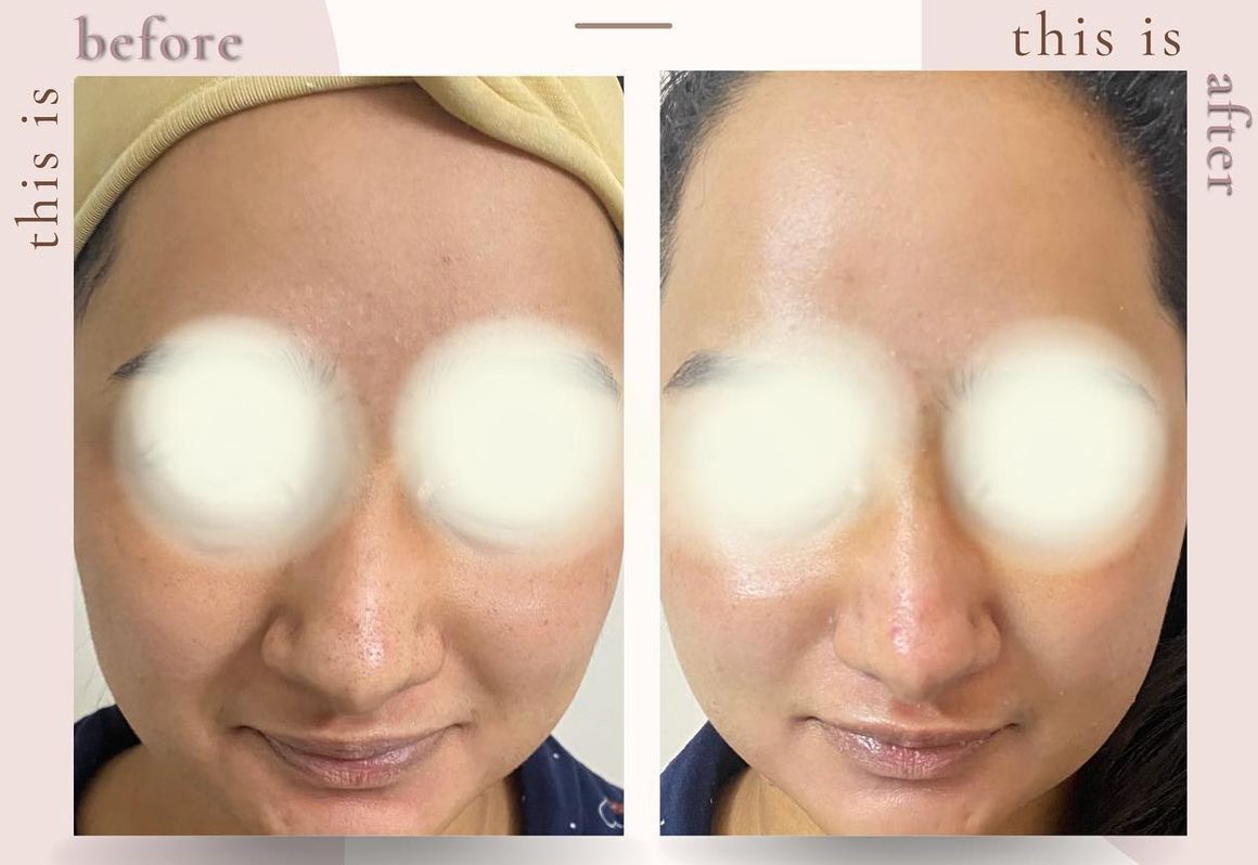 HydraFacial treatment before and after results showing improved skin glow and texture at CheveuDerm Medspa Bangalore