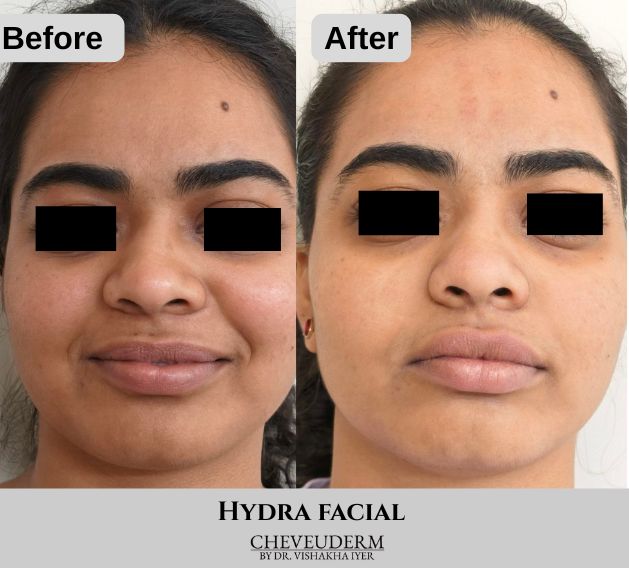 HydraFacial before and after results for acne-prone skin and open pores at Cheveuderm, HBR Layout, Bangalore