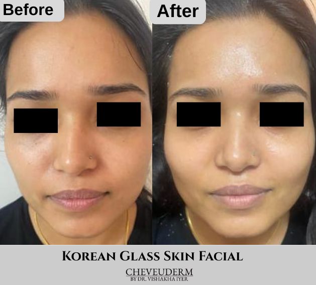 Korean Glass Skin Facial before and after results for pigmentation and dark spots at Cheveuderm, HBR Layout, Bangalore