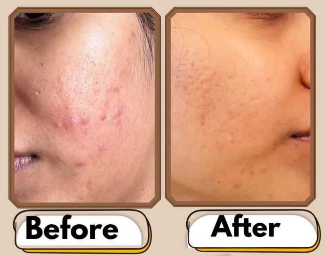 Before and after results of MNRF microneedling radiofrequency treatment for acne scars at Cheveuderm Medspa Bangalore