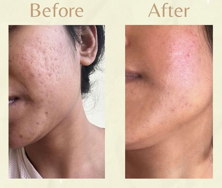 Dermatologist performing MNRF microneedling radiofrequency treatment to reduce acne scars at Cheveuderm Medspa in Bangalore