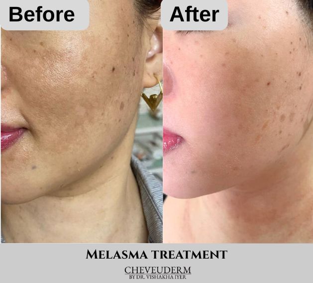 Laser skin treatment before and after results for pigmentation and melasma at Cheveuderm, HBR Layout, Bangalore