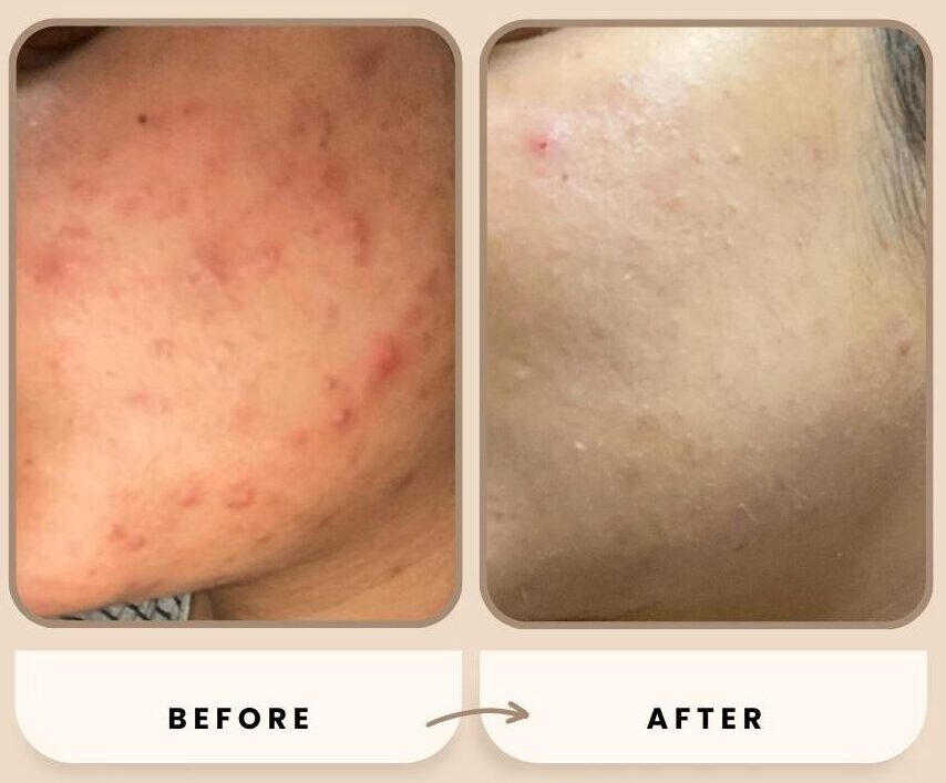 Before and after results of chemical peel treatment for acne marks at CheveuDerm Medspa Bangalore.