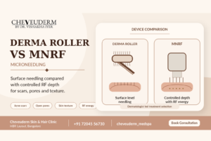 Derma roller vs MNRF microneedling comparison at Cheveuderm Bangalore for acne scars, open pores and skin texture