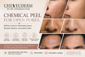Chemical peel for open pores at Cheveuderm Bangalore to improve skin texture and minimise visible pores