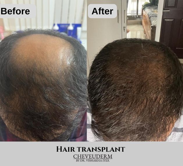 Hair transplant before and after showing full crown restoration and significant improvement in hair density at Cheveuderm Skin and Hair Clinic, HBR Layout, Bangalore — performed by Dr. Vishakha Iyer