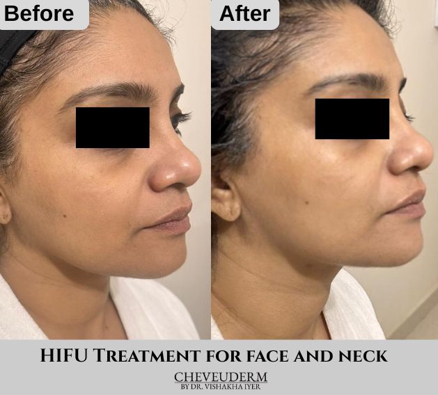 HIFU skin tightening before and after showing jawline definition and neck lift at Cheveuderm, HBR Layout Bangalore — performed by Dr. Vishakha Iyer