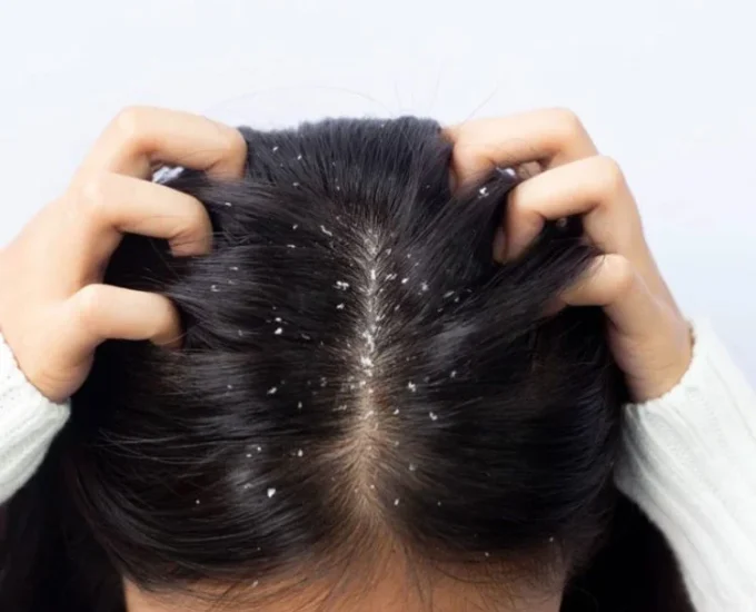 anti-dandruff-treatment-1-750x750