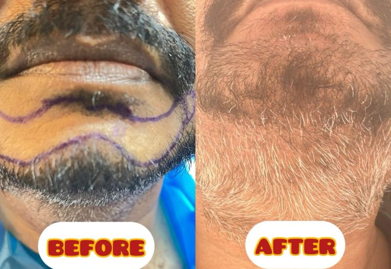 Beard transplant before and after showing significant improvement in patchy beard and chin hair density at Cheveuderm Skin and Hair Clinic, HBR Layout, Bangalore — performed by Dr. Vishakha Iyer