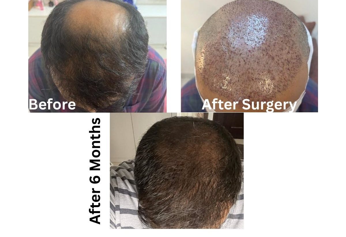 Hair transplant before and after results showing hair density improvement at Cheveuderm Medspa